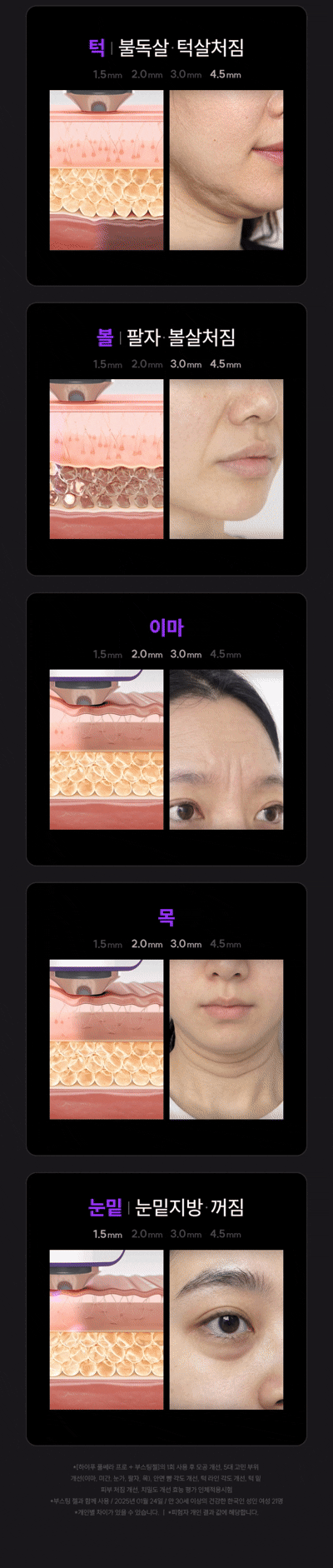 [Jangnara PICK] EOA HIFU PulsseraPRO source detail 45