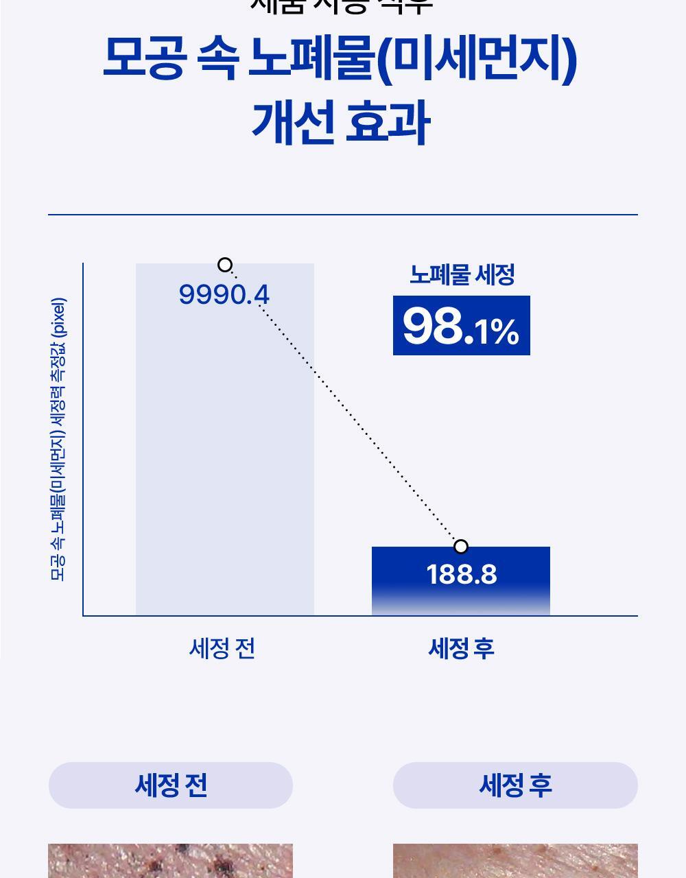 제품 사용 직후 모공 속 피지 블랙헤드 화이트헤드 개선 효과