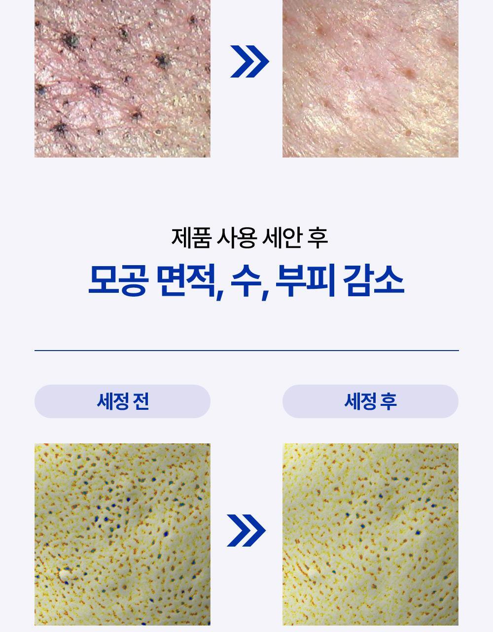 제품 사용 직후 모공 속 피지 블랙헤드 화이트헤드 개선 효과